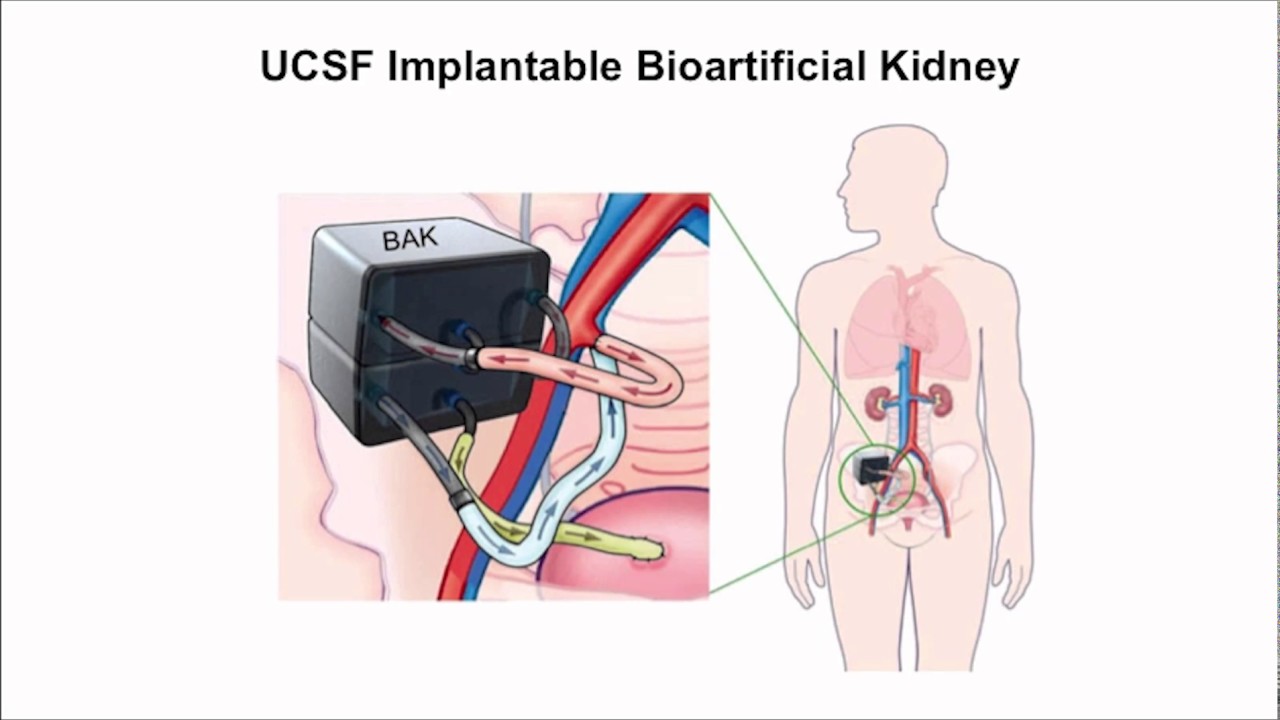 Бионическая почка - сможет ли человечество уйти от диализа?