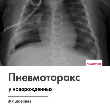 Неонатальный пневмоторокс  у новорожеднных