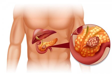 Рак поджелудочной железы: новый подход к лечению?
