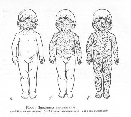 Что мы знаем о кори? Как диагностировать и что делать?