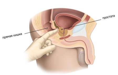 Пальцевое ректальное исследование